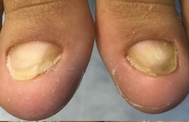 Deforme Tırnak Bakımı